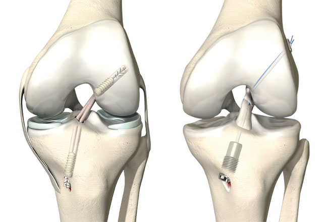Kreuzbandrekonstruktion / Ligamys Kreuzbandrekonstruktion