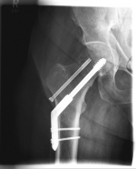 Oberschenkel 2 Oberschenkel 2